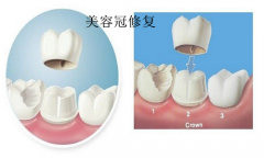 深圳仿生美容冠的适用症都有哪些
