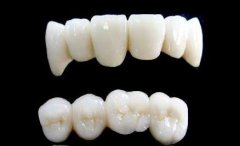 不同种类烤瓷牙价格如何