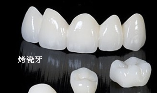 烤瓷牙
