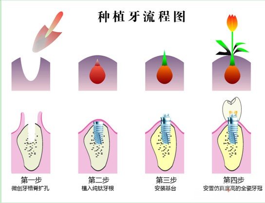 　　牙齿种植