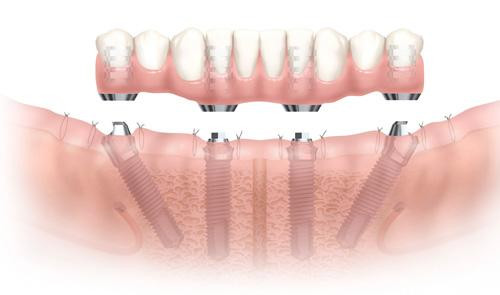 1514016875598529.jpg 多颗牙齿种植6.jpg