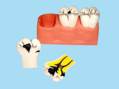  蛀牙怎么治