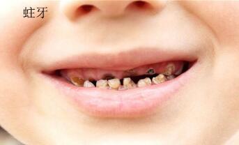 日常如何预防蛀牙？