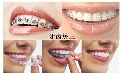 　　牙齿畸形可以矫正治疗