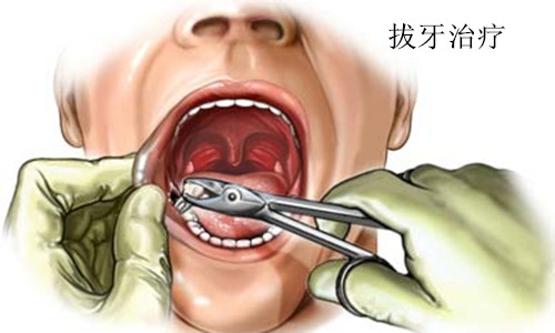 　　拔牙
