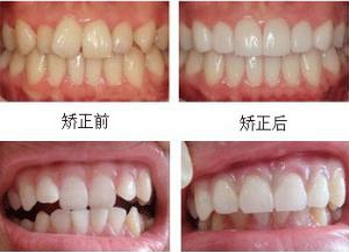 隐形矫正真的那么好吗