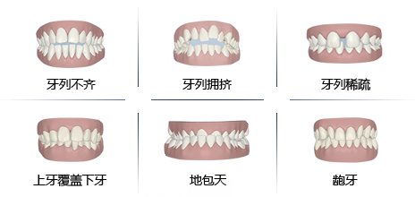 　　儿童牙齿畸形