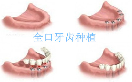 全口牙齿缺失
