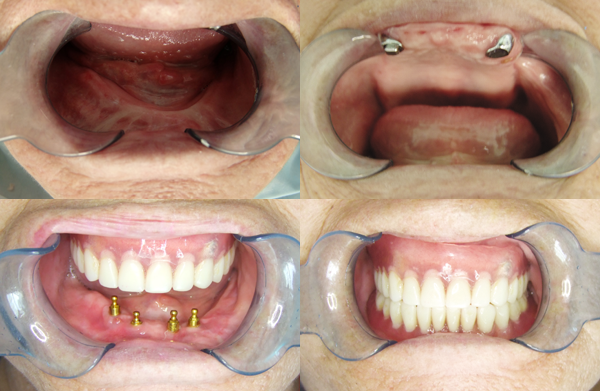 全口牙种植的价格到底是多少