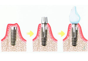 昆山全口牙齿种植能够一直使用吗