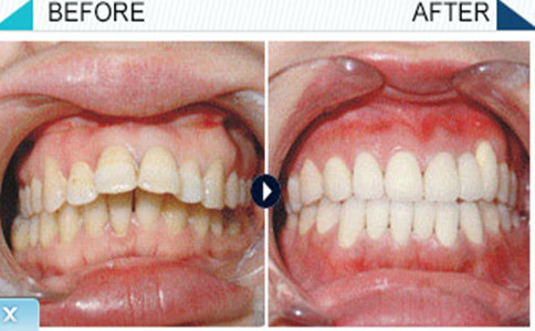 龅牙矫正前后对比图