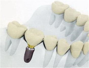 全瓷牙到底好不好呢