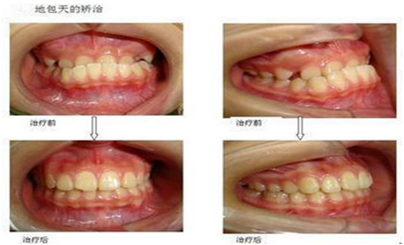 兜齿做牙齿矫正手术的价钱是多少