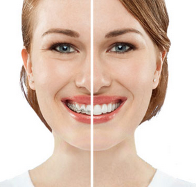 做隐形矫正能看出来矫正吗