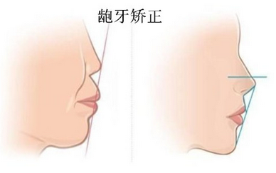 成年人龅牙矫正的方法都有哪些