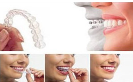 牙齿做隐形矫正要多少钱