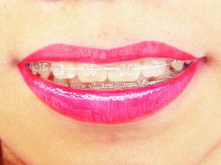 为什么牙齿隐形矫正大受欢迎