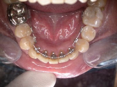 无托槽隐形矫正和牙套的区别