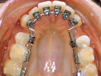 舌侧隐形矫正技术适合成年人吗