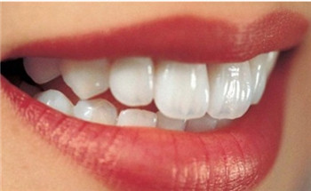 什么牙齿适合做烤瓷牙呢