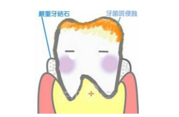 　　影响牙结石