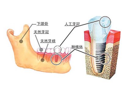 　　种植牙