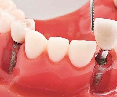 种植牙