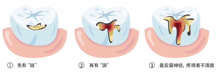 1518165435128079.jpg 蛀牙1.jpg