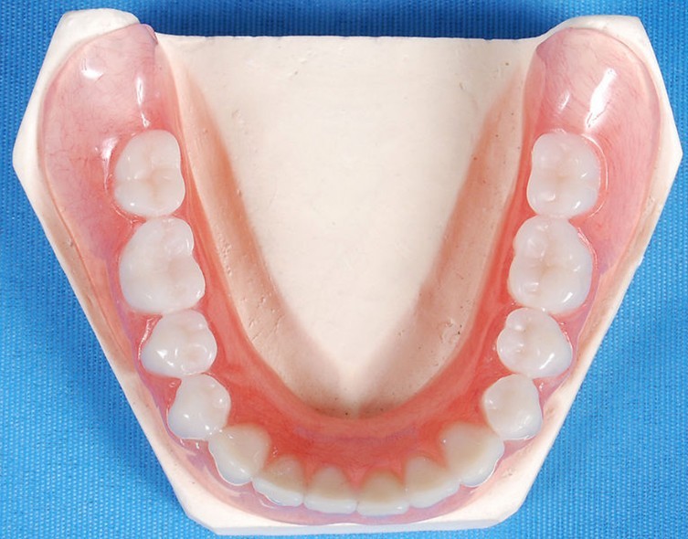 1518318649616215.jpg 活动义齿4.jpg