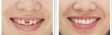 美牙冠修复缺失牙案例