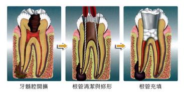 根管治疗