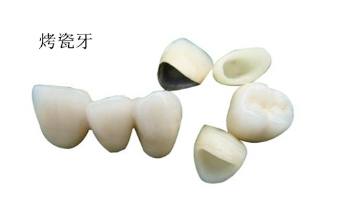 　　烤瓷牙