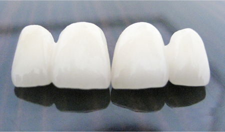 烤瓷牙4.jpg