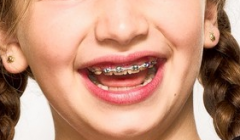 青少年矫正牙齿要注意什么呢