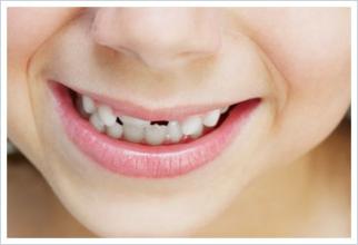 深圳牙齿不齐矫正要花多少钱