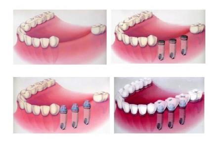 麦芽种植牙修复