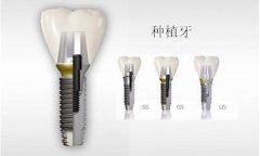 深圳种植牙能用多长时间呢