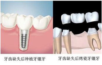 种植牙需要做几次手术呢