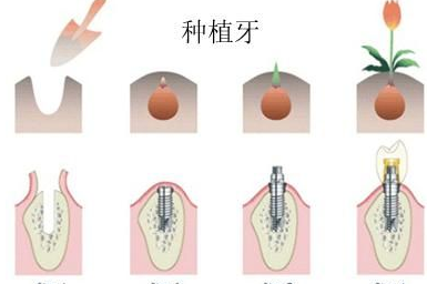 不得不选种植牙的六个理由