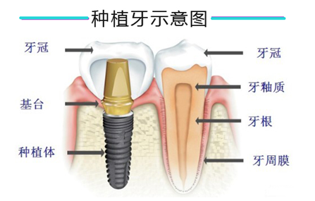 深圳全口种植牙的价格