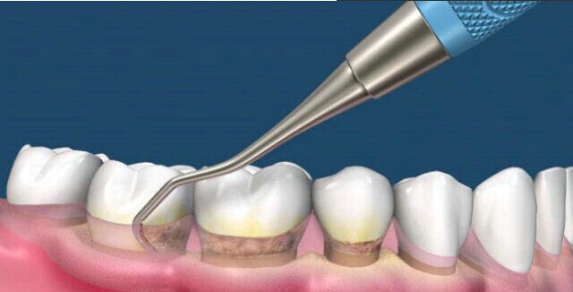 深圳牙结石洗牙的需要多少钱