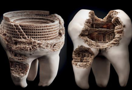 深圳补一个牙洞多少钱