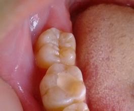 深圳补牙去哪家好呢