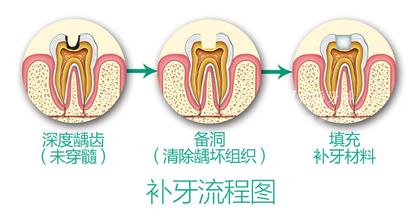 深圳牙齿有洞补一下需要多少钱
