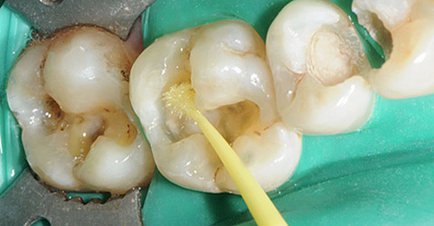 深圳龋齿补牙价格多少
