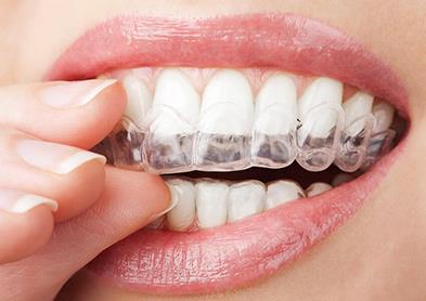 矫正牙齿牙套通常戴多久