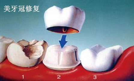 美容冠多少钱一颗