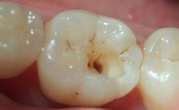 深圳蛀牙治疗要多少钱