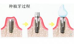 种植牙之后要怎么做护理