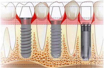 做种植牙需要哪些条件？
